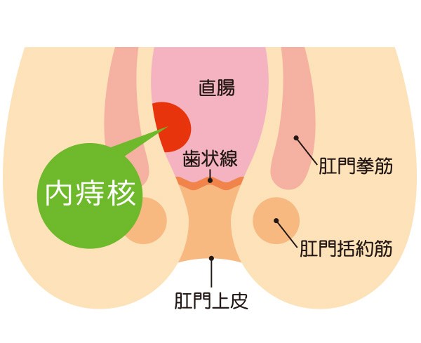 内痔核について