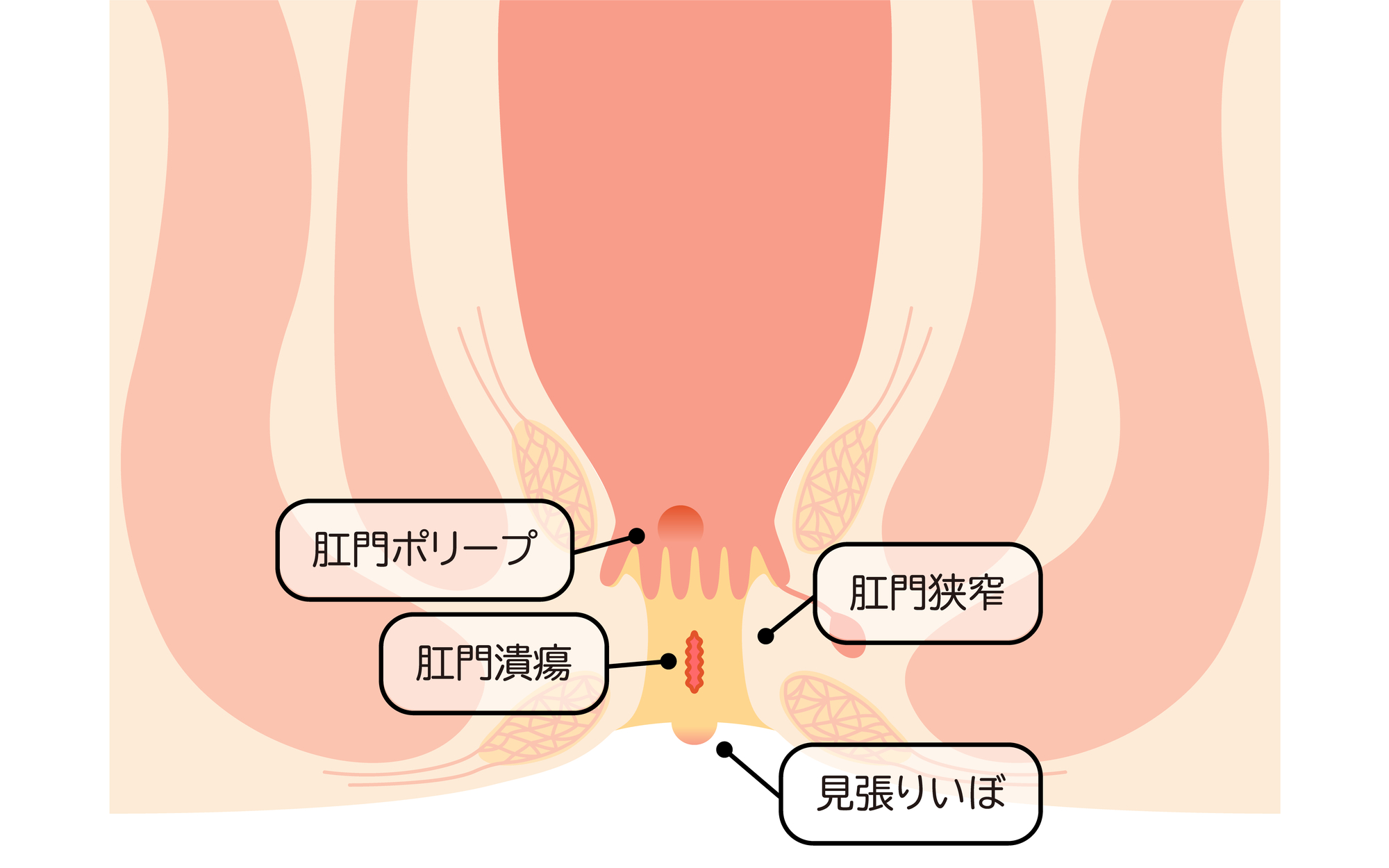 繰り返す切れ痔は注意が必要です