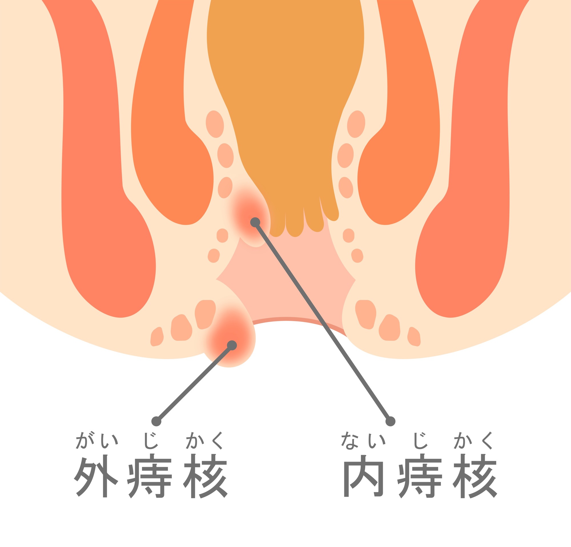 いぼ痔とは