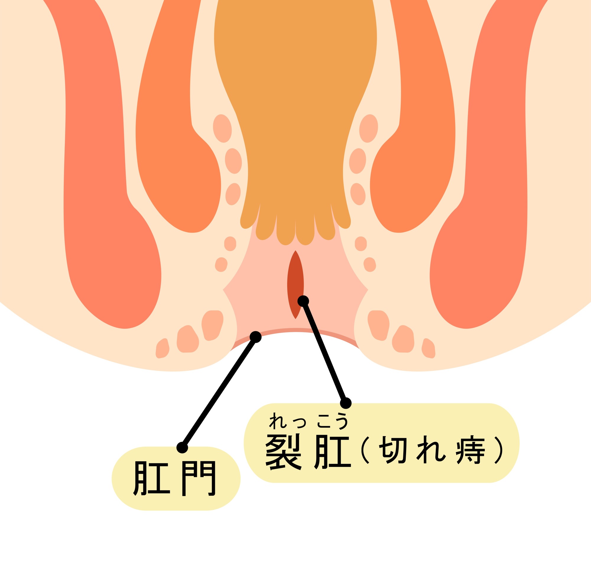 切れ痔とは